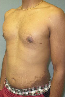 Severe Gynecomastia