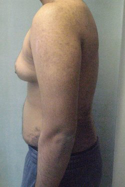 Severe Gynecomastia