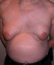 Severe Gynecomastia