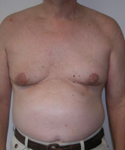 Severe Gynecomastia