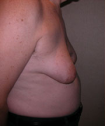 Severe Gynecomastia