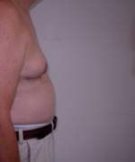 Severe Gynecomastia