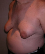 Severe Gynecomastia