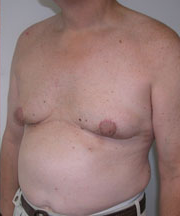 Severe Gynecomastia