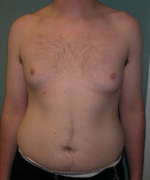 Severe Gynecomastia