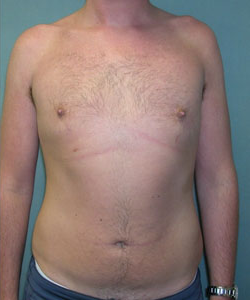 Severe Gynecomastia After Photo Severe Gynecomastia