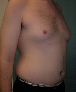 Severe Gynecomastia