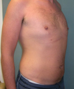 Severe Gynecomastia