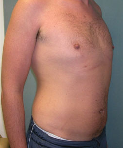 Severe Gynecomastia