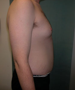 Severe Gynecomastia