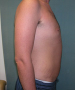 Severe Gynecomastia