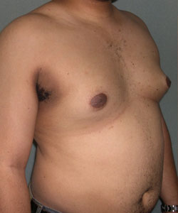 Severe Gynecomastia