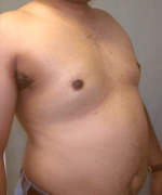 Severe Gynecomastia