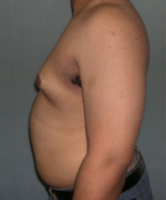 Severe Gynecomastia