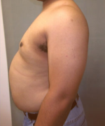 Severe Gynecomastia