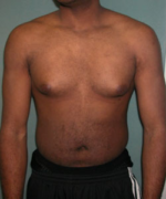 Severe Gynecomastia