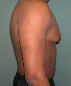 Severe Gynecomastia