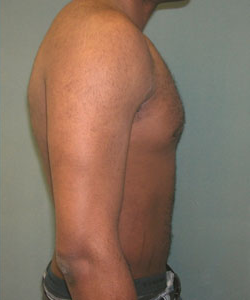 Severe Gynecomastia