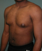 Severe Gynecomastia