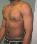 Severe Gynecomastia