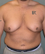 Severe Gynecomastia