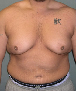 Severe Gynecomastia