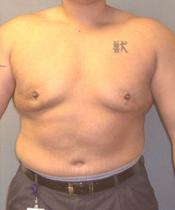 Severe Gynecomastia