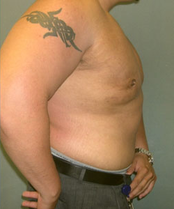 Severe Gynecomastia