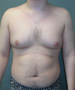 Severe Gynecomastia Before Photo Severe Gynecomastia