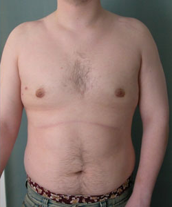 Severe Gynecomastia