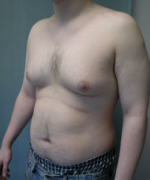 Severe Gynecomastia