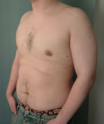 Severe Gynecomastia