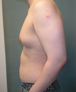 Severe Gynecomastia