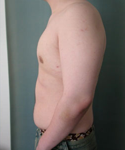 Severe Gynecomastia