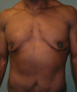 Severe Gynecomastia Before Photo Severe Gynecomastia