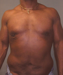 Severe Gynecomastia After Photo Severe Gynecomastia