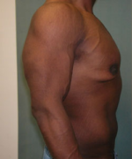 Severe Gynecomastia