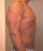 Severe Gynecomastia