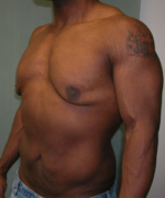 Severe Gynecomastia