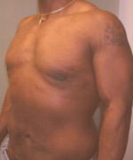 Severe Gynecomastia