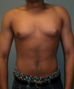 Severe Gynecomastia