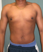 Severe Gynecomastia