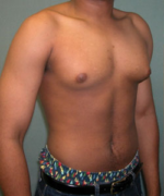 Severe Gynecomastia