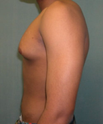 Severe Gynecomastia