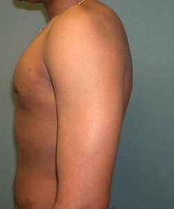 Severe Gynecomastia