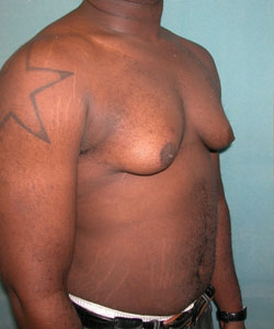 Severe Gynecomastia