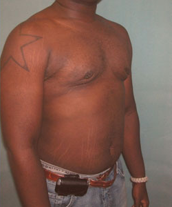 Severe Gynecomastia