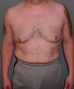 Severe Gynecomastia