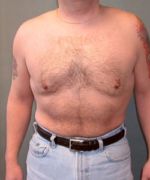 Severe Gynecomastia