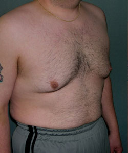 Severe Gynecomastia